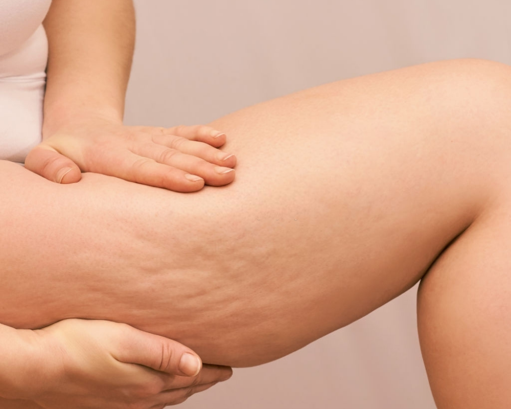 What Diet is Best to get rid of Cellulite? – Part 1